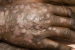 World Psoriasis Day