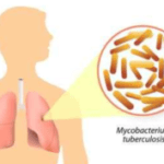 Elimination of Tuberculosis from India