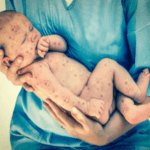 Study on India’s Measles Campaign