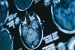 India finds a tool to get deeper insight into Parkinson’s Disease