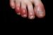 What is COVID Toe?