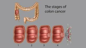 Colon Cancer Can be detected through Body Fluids: Research