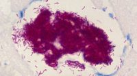 Buruli ulcer