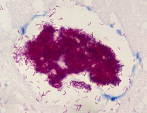 Buruli ulcer