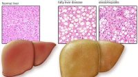 Operational Guidelines for integration of Non-Alcoholic Fatty Liver Disease with NPCDCS