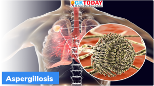 एस्परगिलोसिस फंगल संक्रमण (Aspergillosis Fungal Infection) क्या है?
