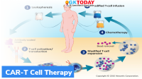 First CAR-T Cell Therapy Conducted