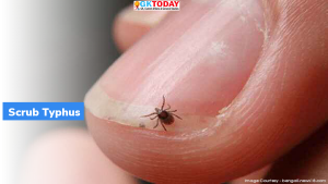 स्क्रब टाइफस (Scrub Typhus) क्या है?