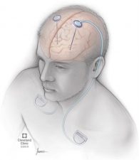Deep Brain Stimulation