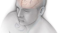 Deep Brain Stimulation