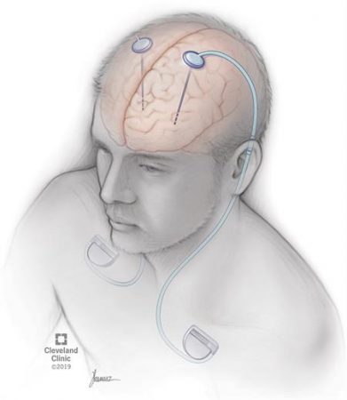 Deep Brain Stimulation – GKToday