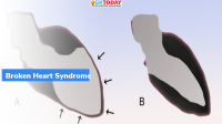 Takotsubo Syndrome
