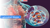 Legionnaires’ disease