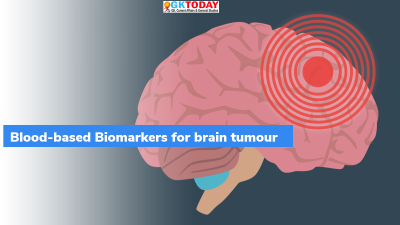IISc- Biomarkers to predict disease progression in brain tumour