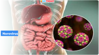 Surge in Norovirus Cases in UK