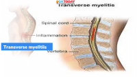 Transverse myelitis