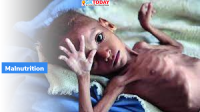 Assam Mission on Malnutrition – Project Parvarish