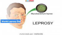World Leprosy Day