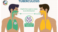 Dare to Erade TB Program for WGS TB Surveillance