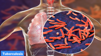National Tuberculosis Prevalence Survey