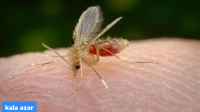 Kala Azar (Black fever) Case in West Bengal