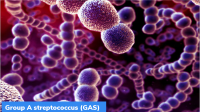 Surge in iGAS Cases in the UK