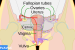 CERVAVAC: Cervical Cancer Vaccine