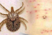Scrub Typhus Claims Lives in Odisha’s Bargarh District
