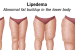 What is Lipedema?