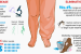 Uttar Pradesh Launches Campaign to Eradicate Filariasis