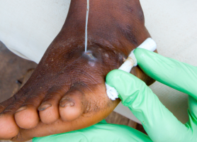 Guinea Worm Disease Nears Eradication 