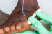 Guinea Worm Disease Nears Eradication 