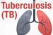 India registers 16% decline in TB incidence: Annual India TB report 