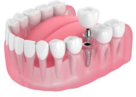 Union Ministry Developing Fabric-Based Tooth Implants for Cost-Efficiency