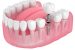 Union Ministry Developing Fabric-Based Tooth Implants for Cost-Efficiency