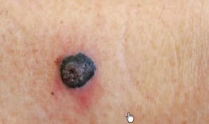 World’s First Personalised mRNA Vaccine for Melanoma Undergoing Trials