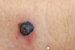 World’s First Personalised mRNA Vaccine for Melanoma Undergoing Trials