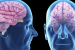 Is Donanemab a Breakthrough Treatment for Alzheimer’s?