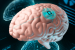 World’s First Brain Implant for Epilepsy Control