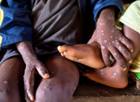 Africa Faces Urgent Mpox Outbreak, WHO Holds Emergency Meeting