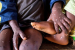 Africa Faces Urgent Mpox Outbreak, WHO Holds Emergency Meeting