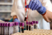 New Blood Test Detects Alzheimer’s with 90% Accuracy
