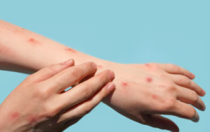 Sweden Reports First Case of mpox Strain outside Africa