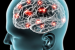 Study Highlights Gut-Brain Link in Parkinson’s Disease