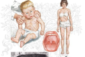 What is Nemaline Myopathy?