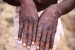 Mpox Virus – Recent Developments and Concerns