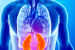 What is Cardiovascular Kidney Metabolic Syndrome?