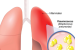 What is Walking Pneumonia?