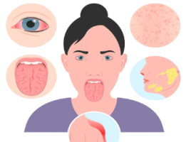 What is Sjögren’s Syndrome?
