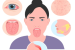 What is Sjögren’s Syndrome?